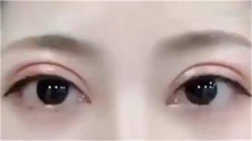 三、术后特殊并发症需警惕