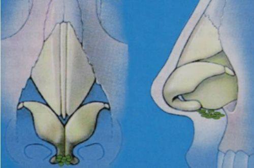 二、针对特殊眼部情况的医美修复方案