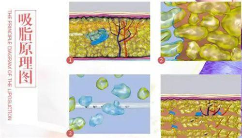 四、这些特定人群手术风险极高，需谨慎或避免