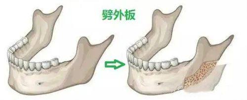 二、术后长期:针对性治疗,攻克顽固疤痕
