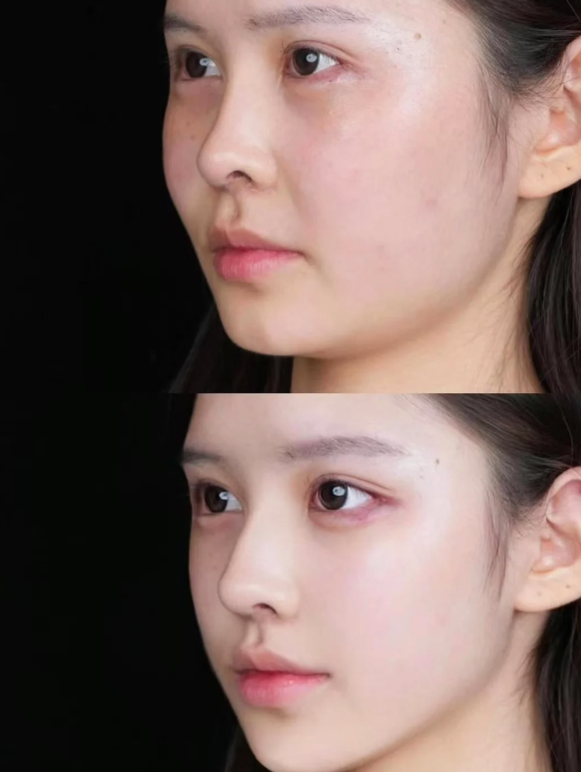 二、各类皮肤损伤：疤痕疙瘩的直接触发开关