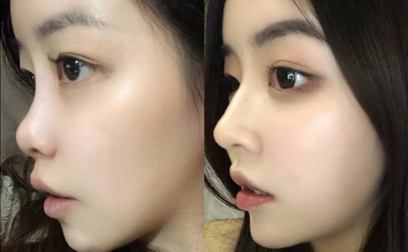 三、药物与封闭针：初期轻症疤痕的保守处理