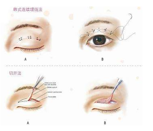 三、做完眼袋手术的戒烟时长建议