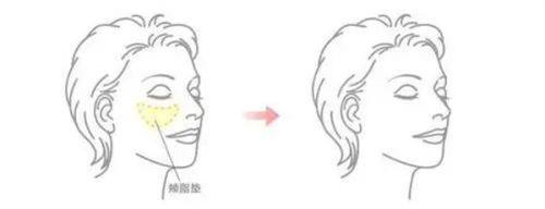 五、手臂吸脂一个月还没瘦怎么办