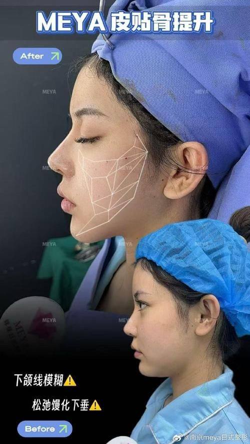 李若华医生技术优势：