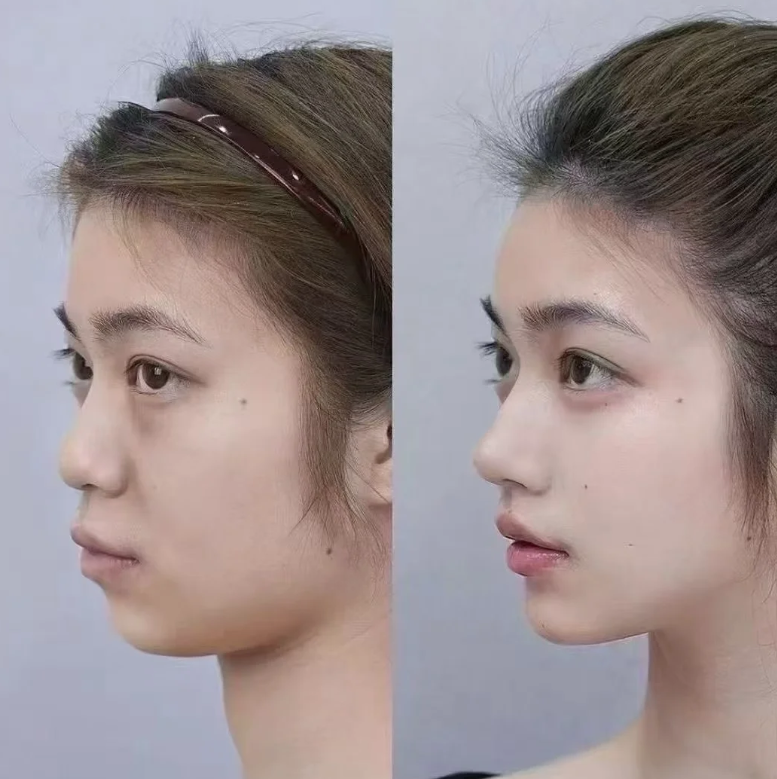 五、去眼袋后为什么会变老,问题出在哪