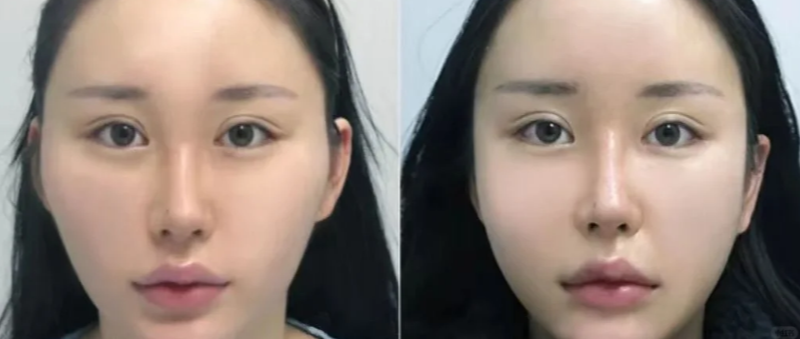 三、手臂吸脂快一个月了感觉还是特别粗,该怎么办