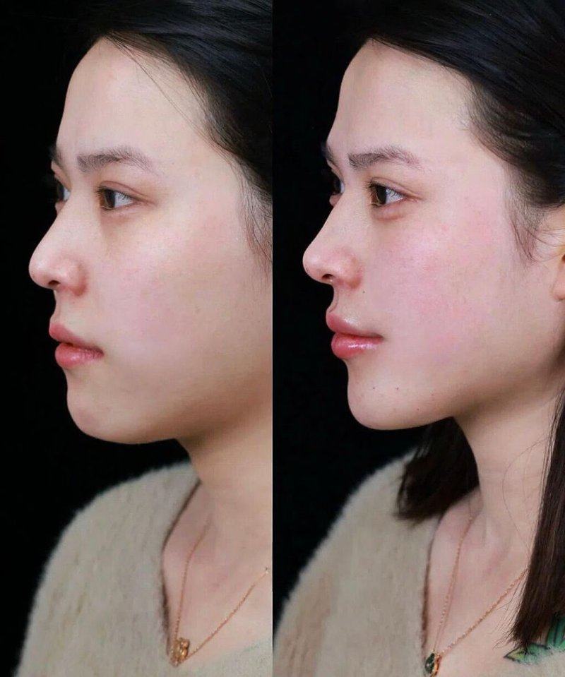 二、做完眼袋手术抽烟的具体危害