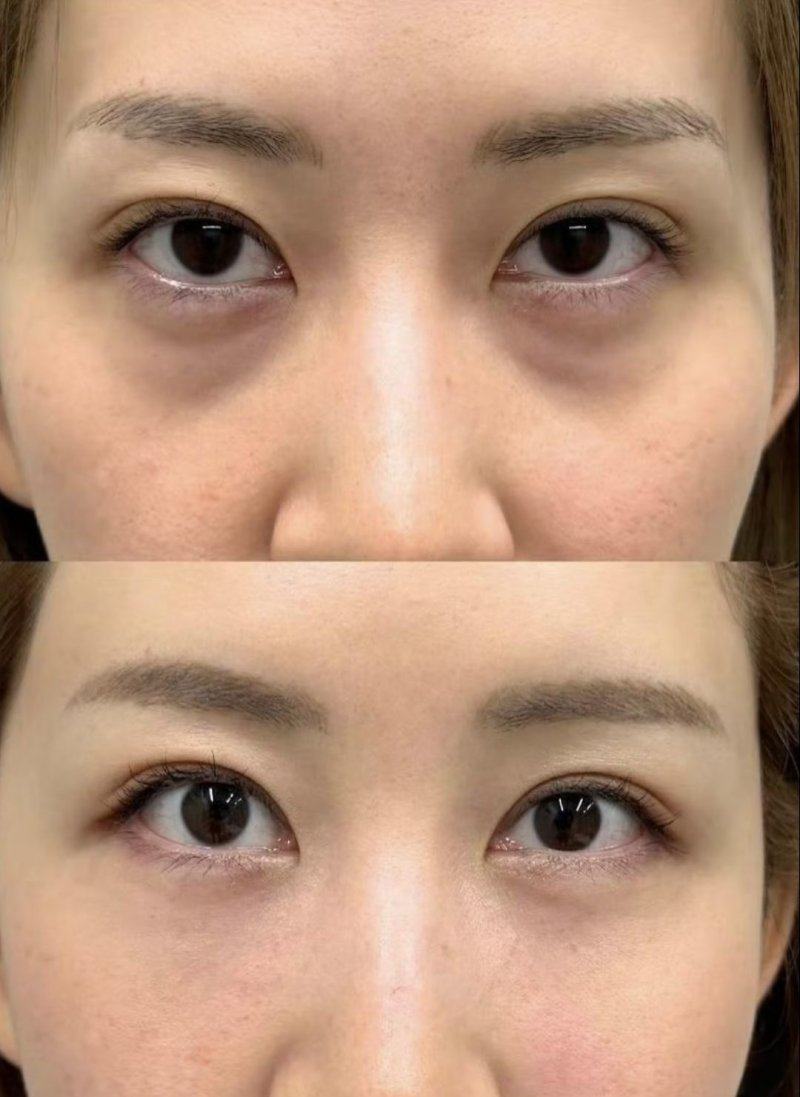 二、祛眼袋之后为什么觉得还有眼袋
