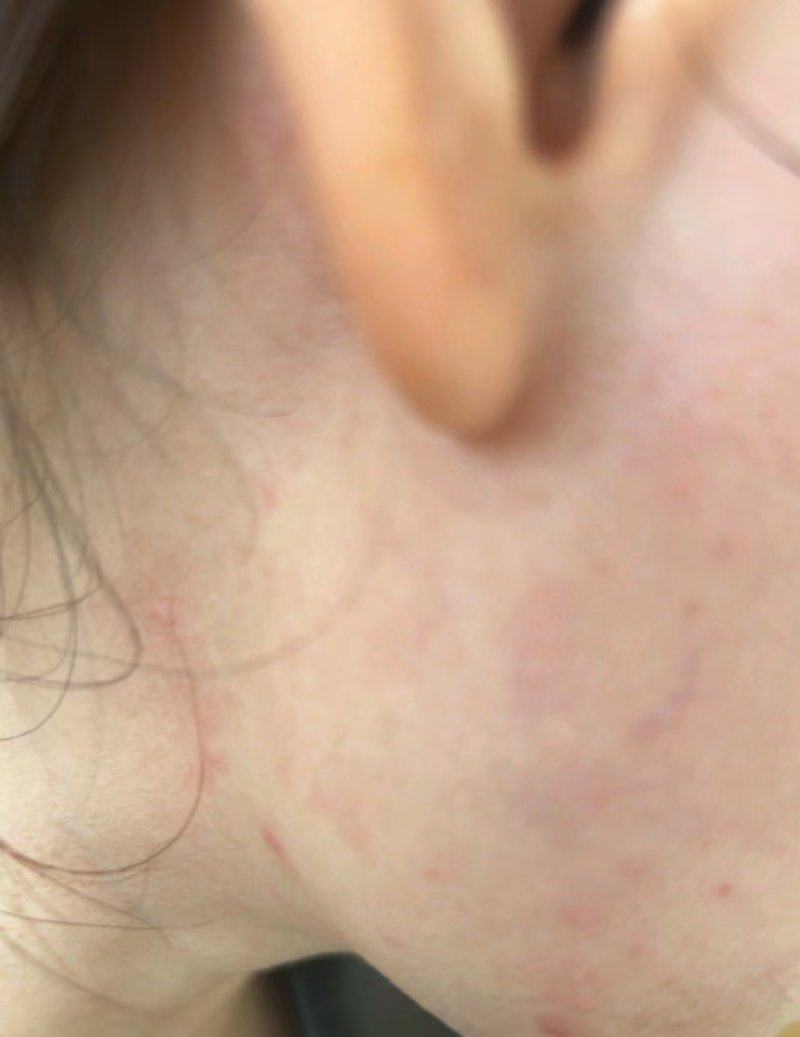 首次体验曹珂医生的医美项目：过程舒适痛感可接受，满心期待变美效果显现