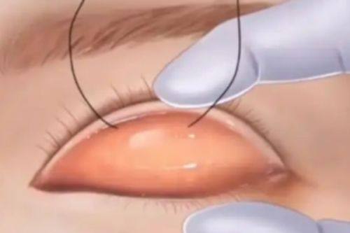 二、手术方式复杂度：决定价格高低的核心变量