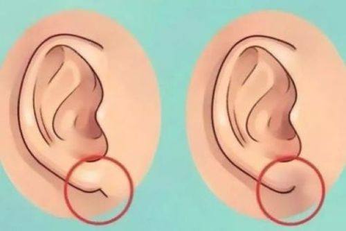 五、子宫疤痕修复手术的风险不可忽视