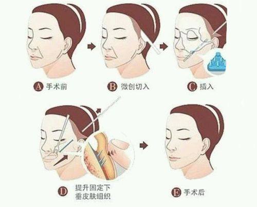 三、双眼皮手术的常见疑问解析