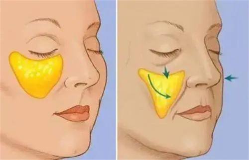 三、疤痕子宫怎么修复更好？选对方法是核心