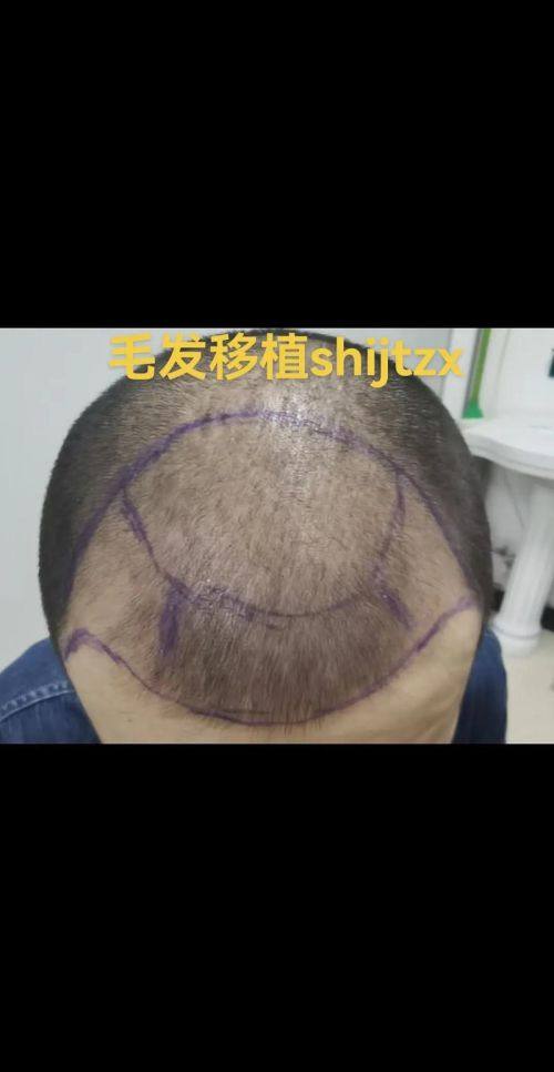 锦州福际植发地址电话及营业时间: