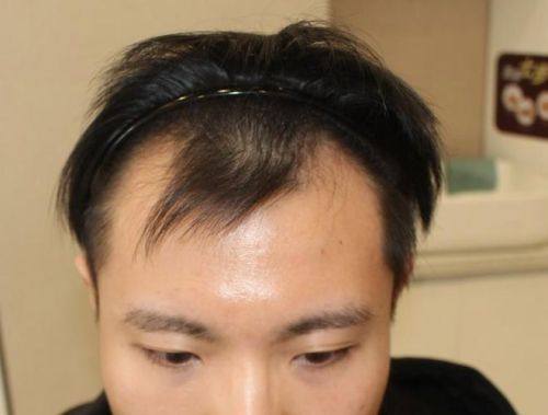 锦州福际植发怎么样?