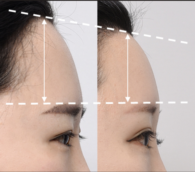 六、关于疤痕子宫修复的常见疑问解答