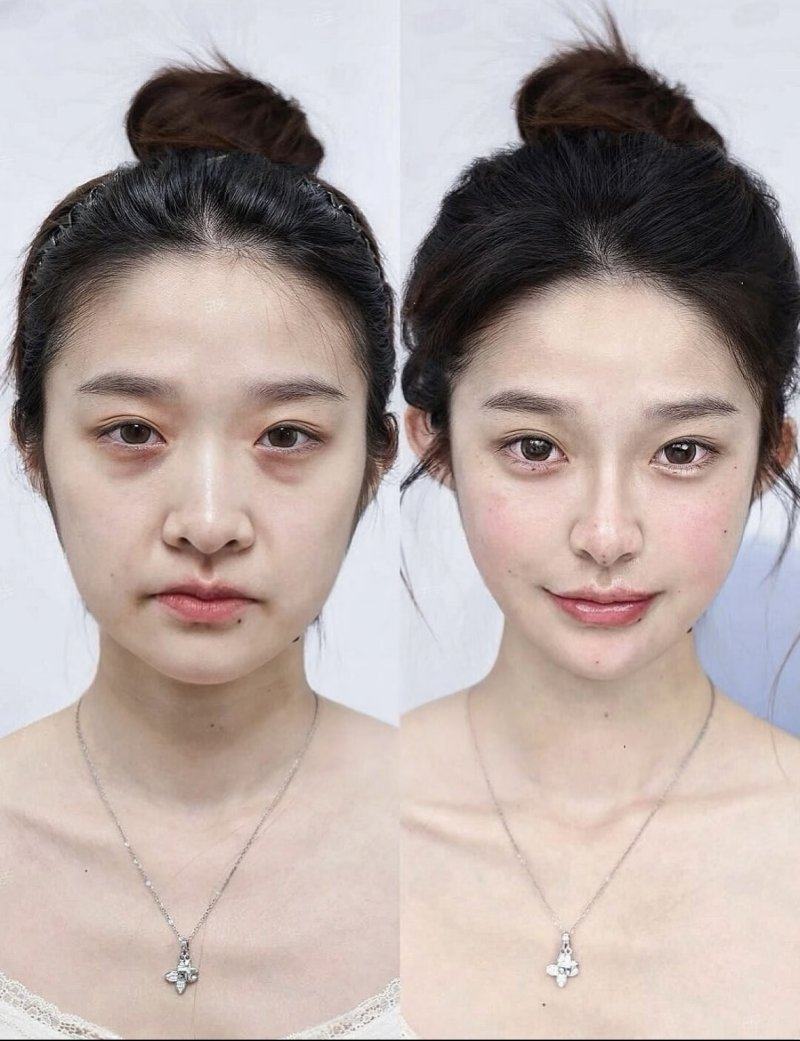 五、附加项目叠加：眼周综合项目推高总价