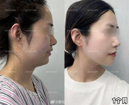 临海裕雅整形医院价格表：