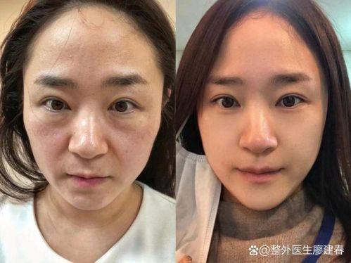 曹燕医生技术优势