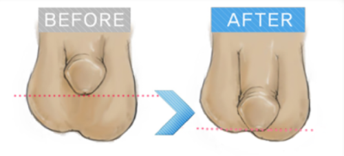 四、凸起疤痕的日常护理与注意事项