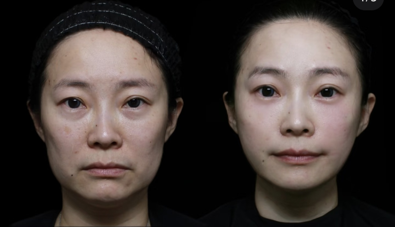 去眼袋和黑眼圈的日常小妙招