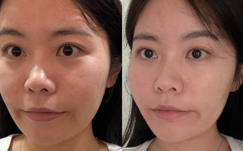 去眼袋和黑眼圈避坑指南