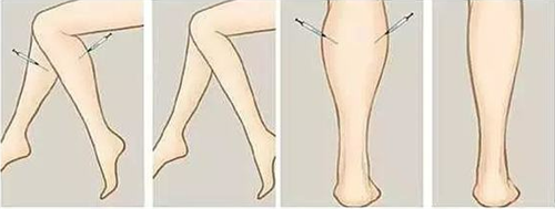 三、埋线双眼皮能维持多久