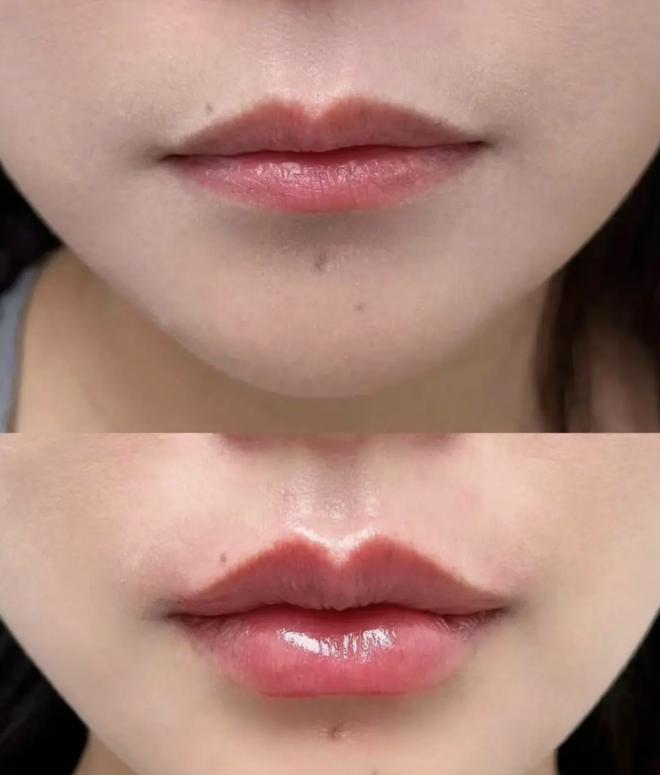 二、祛眼袋有几种做法：手术类祛眼袋详解