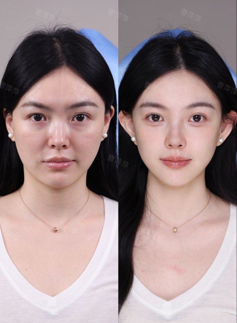 三、自然衰老型眼袋的出现规律