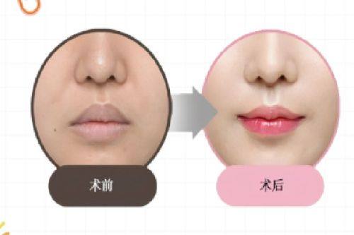 二、先涂疤痕膏再贴疤痕贴的核心逻辑