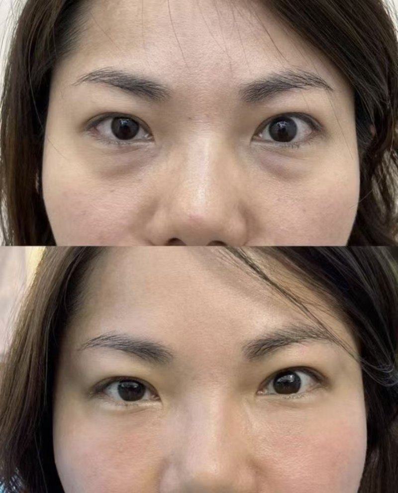 四、疤痕体质的小孩疤怎么去掉