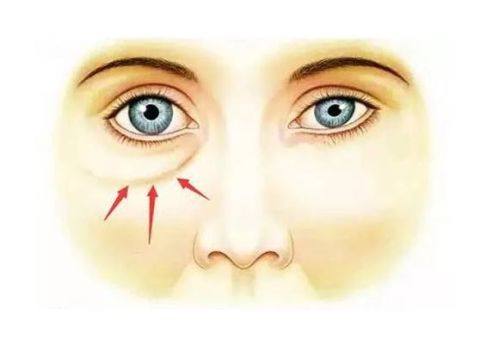 三、孩子眼袋大怎么办呢