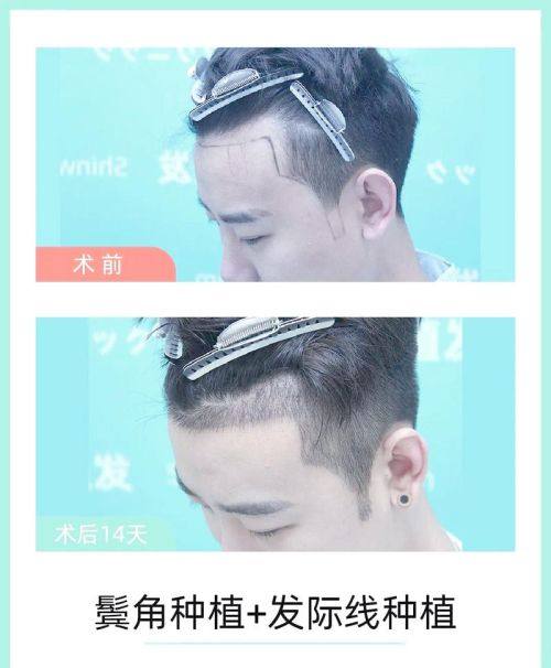 兰州新禾植发美容诊所口碑评价：