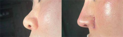 二、不同类型烫伤疤痕的针对性治疗方案