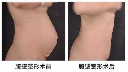 五、未生育女性也可放心选择隆胸，术后哺乳不受影响