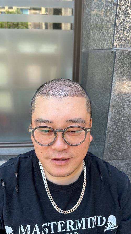 西安沐森植发价格表