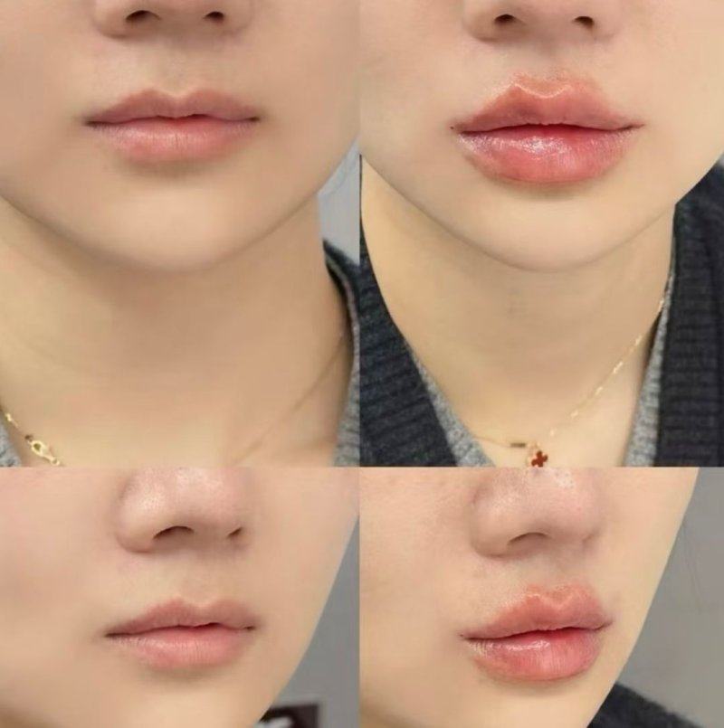 三、主流烫伤疤痕祛疤技术详解