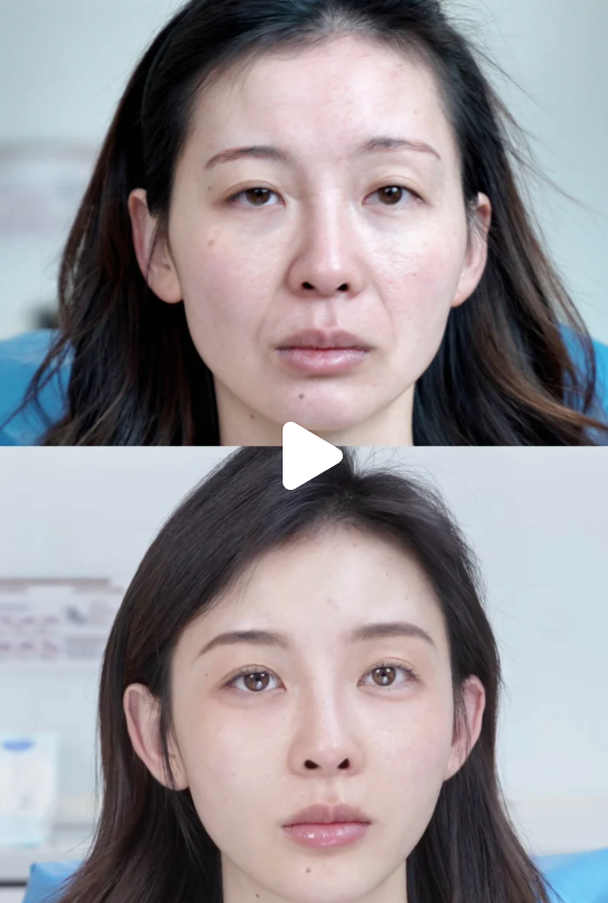 四、复合隆胸：兼顾美观与哺乳安心的双重优势