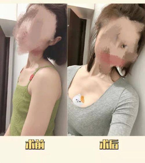 广州美菲斯整形医院口碑评价：