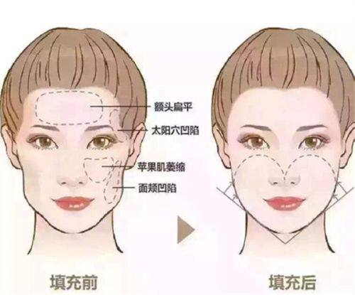 六、一万多假体隆胸的避坑指南