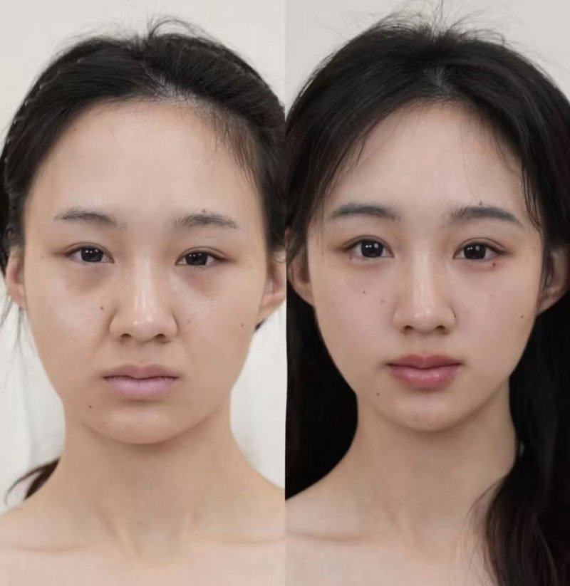 五、术后护理注意事项