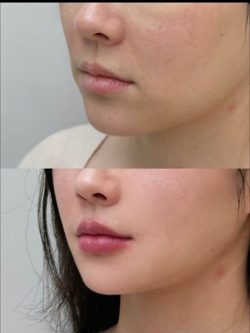 六、脸上烧伤的疤痕怎么除掉术后护理要点