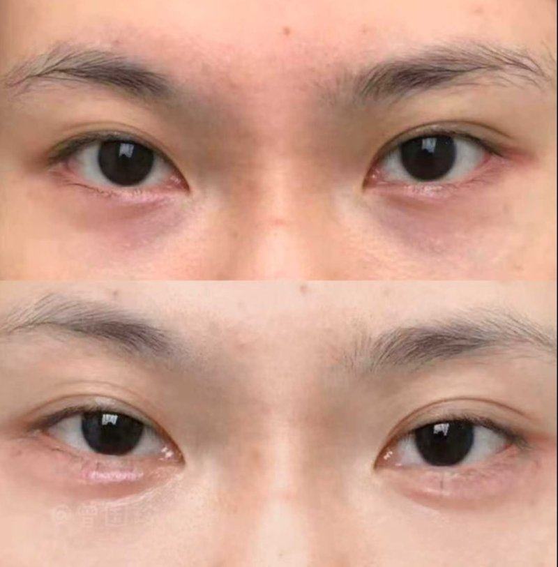 二、不同祛眼袋术式的复发率差异