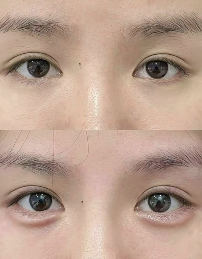 四、眼袋术后复发后的改善方法