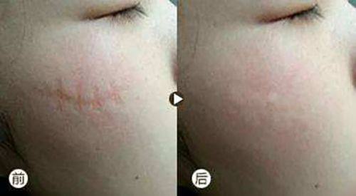 三、不同眼部基础的术后放大差异