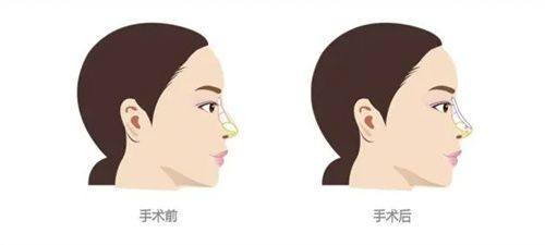 四、注射瘦脸针有什么危害？常见副作用及风险