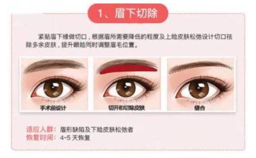 五、微创埋线双眼皮多长时间能完全修复好？