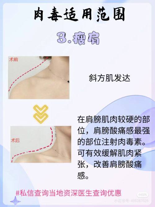 三、微创埋线双眼皮VS全切双眼皮，哪个更好？