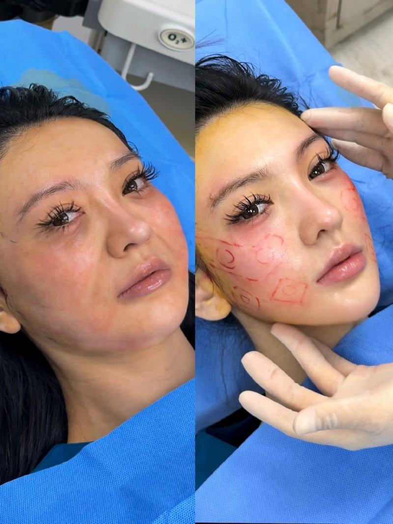 四、自体脂肪隆胸的风险与安心性解析